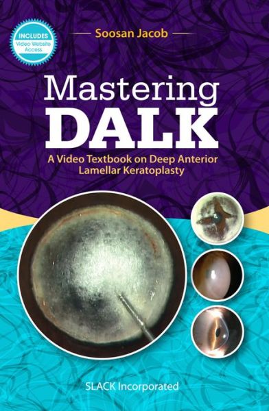 Cover for Soosan Jacob · Mastering DALK: A Video Textbook on Deep Anterior Lamellar Keratoplasty (Paperback Book) (2019)