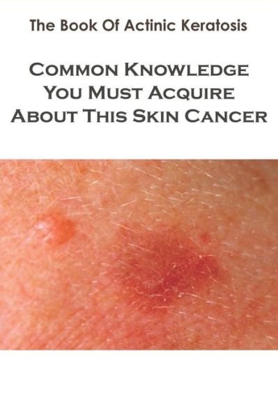 Cover for Tiffani Cerdan · The Book Of Actinic Keratosis_ Common Knowledge You Must Acquire About This Skin Cancer (Paperback Bog) (2020)