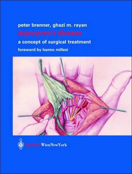 Cover for P. Brenner · Dupuytren's Disease: a Concept of Surgical Treatment (Hardcover Book) (2003)