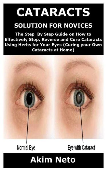 Cataracts Solution for Novices - Akim Neto - Książki - Independently Published - 9798585885570 - 23 grudnia 2020