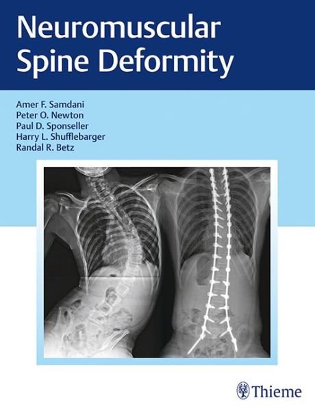 Neuromuscular Spine Deformity - Samdani Amer - Books - Thieme Medical Publishers Inc - 9781626232600 - May 23, 2018