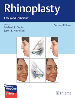 Cover for Michael S. Godin · Rhinoplasty: Cases and Techniques (N/A) [2 New edition] (2025)