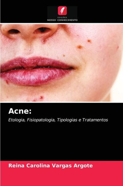 Cover for Reina Carolina Vargas Argote · Acne (Paperback Book) (2021)