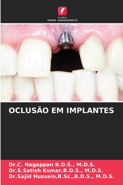 Oclusao Em Implantes - M D S Dr C Nagappan B D S - Books - Edicoes Nosso Conhecimento - 9786203948608 - July 20, 2021