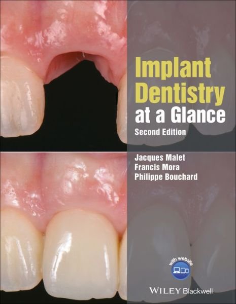 Cover for Malet, Jacques ( Assistant Professor of Clinical Dentistry, Functional Unit in Pathology-Oral Surgery-Periodontics, Rothschild Hospital, A.P.-H.P., Paris, France) · Implant Dentistry at a Glance - At a Glance (Dentistry) (Paperback Book) (2018)