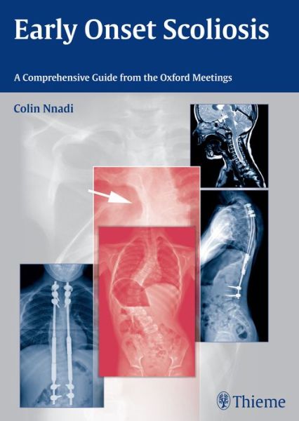 Early Onset Scoliosis: A Comprehensive Guide from the Oxford Meetings - Colin Nnadi - Livres - Thieme Publishing Group - 9783131726612 - 5 août 2015