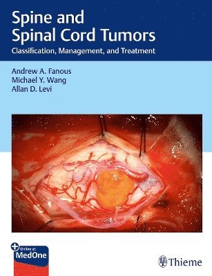 Cover for Andrew Fanous · Spine and Spinal Cord Tumors: Classification, Management, and Treatment (N/A) [New edition] (2025)
