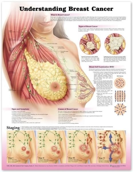 Cover for Anatomical Chart Company · Understanding Breast Cancer 3E Paper (Map) [3 Rev edition] (2012)