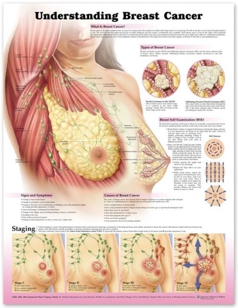 Cover for Anatomical Chart Company · Understanding Breast Cancer 3E Paper (Kort) [3 Rev edition] (2012)