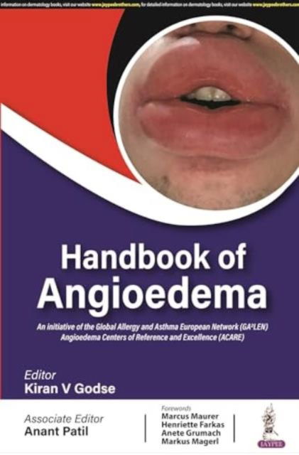 Cover for Kiran V Godse · Handbook of Angioedema (Paperback Book) (2023)