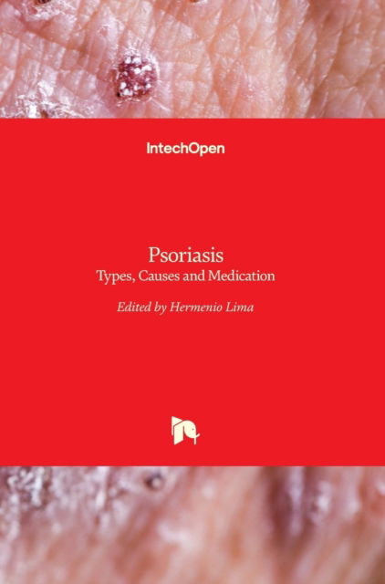 Psoriasis: Types, Causes and Medication - Hermenio Lima - Books - In Tech - 9789535110651 - April 17, 2013