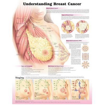 Cover for Anatomical Chart Company · Understanding Breast Cancer 3E Laminated (Map) [3 Rev edition] (2012)