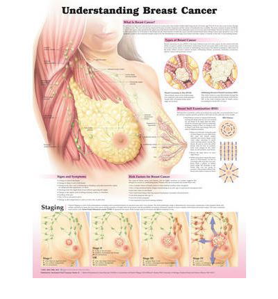 Cover for Anatomical Chart Company · Understanding Breast Cancer 3E Laminated (Kort) [3 Rev edition] (2012)