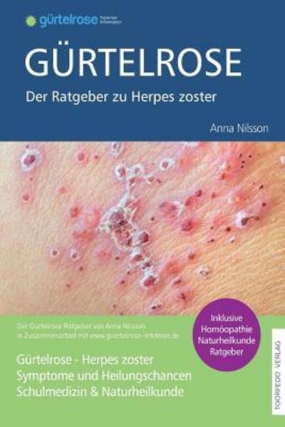 Cover for Anna Nilsson · Gurtelrose - Der grosse Ratgeber zu Herpes zoster (Paperback Book) (2016)