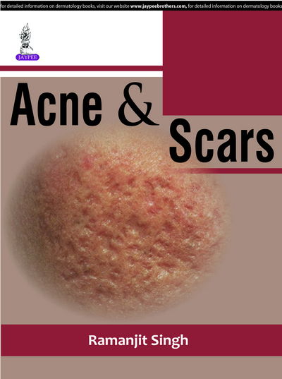 Cover for Ramanjit Singh · Acne &amp; Scars (Taschenbuch) (2016)