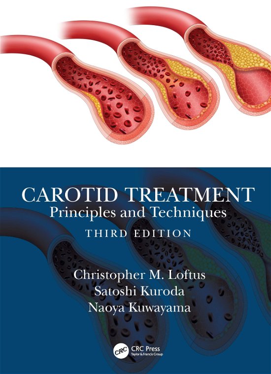 Cover for Loftus, Christopher Miranda (Center for Devices and Radiological Health, USA) · Carotid Treatment: Principles and Techniques (Gebundenes Buch) (2023)