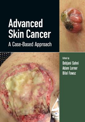 Cover for Advanced Skin Cancer: A Case-Based Approach (Hardcover Book) (2022)