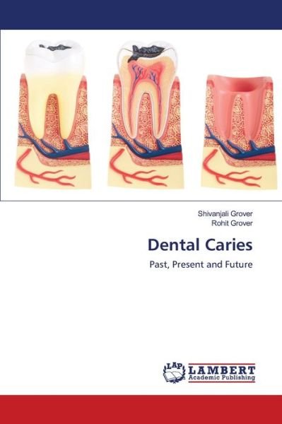 Cover for Grover · Dental Caries (Book) (2020)