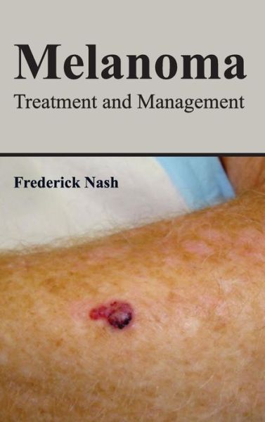 Cover for Frederick Nash · Melanoma: Treatment and Management (Hardcover Book) (2015)