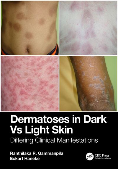 Cover for Gammanpila, Ranthilaka R. (Teaching Hospital Kalutara, Sri Lanka) · Dermatoses in Dark Vs Light Skin: Differing Clinical Manifestations (Paperback Book) (2025)