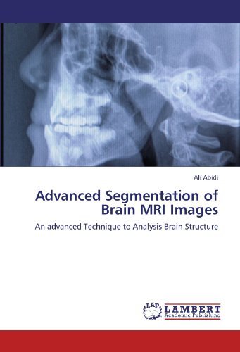 Cover for Ali Abidi · Advanced Segmentation of Brain Mri Images: an Advanced Technique to Analysis Brain Structure (Paperback Bog) (2012)