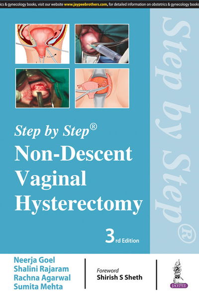 Cover for Neerja Goel · Step by Step: Non-Descent Vaginal Hysterectomy (Paperback Book) [3 Revised edition] (2017)