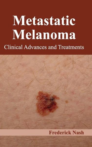 Metastatic Melanoma: Clinical Advances and Treatments - Frederick Nash - Books - Foster Academics - 9781632422767 - January 26, 2015