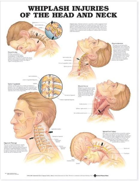 Cover for Anatomical Chart Company · Whiplash Injuries of the Head and Neck Anatomical Chart (Hardcover bog) (2000)