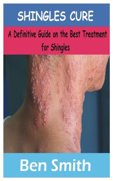 Cover for Ben Smith · Shingles Cure: A Definitive Guide on the best treatment for shingles (Paperback Book) (2020)