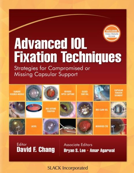 Cover for David F. Chang · Advanced IOL Fixation Techniques: Strategies for Compromised or Missing Capsular Support (Hardcover Book) (2019)