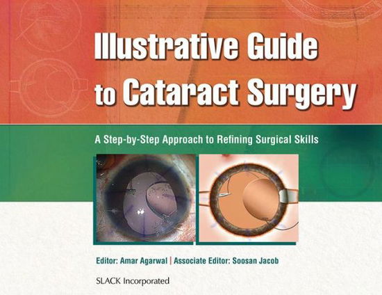 Cover for Amar Agarwal · Illustrative Guide to Cataract Surgery: A Step-by-Step Approach to Refining Surgical Skills (Hardcover Book) (2011)