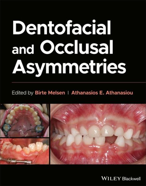 Cover for Melsen · Dentofacial and Occlusal Asymmetries (Hardcover Book) (2024)