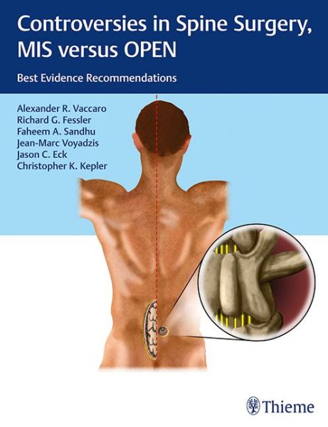 Cover for Alexander R. Vaccaro · Controversies in Spine Surgery, MIS versus OPEN: Best Evidence Recommendations (Hardcover Book) [1th edição] (2018)