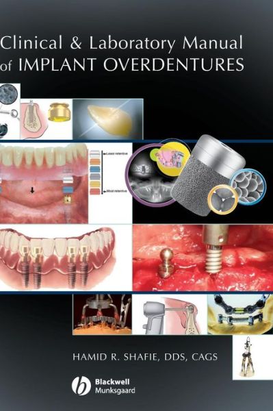 Cover for Shafie, Hamid R. (President, American Institute of Implant Dentistry) · Clinical and Laboratory Manual of Implant Overdentures (Hardcover Book) (2007)