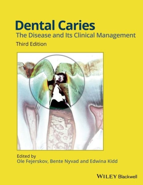 Dental Caries: The Disease and its Clinical Management - O Fejerskov - Books - John Wiley and Sons Ltd - 9781118935828 - May 8, 2015