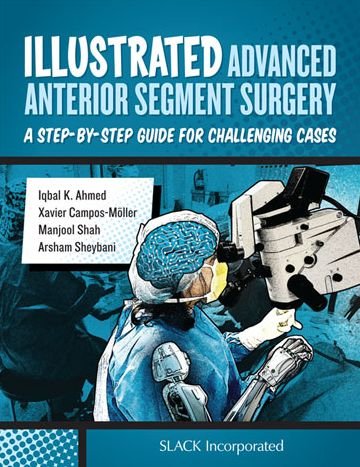 Cover for Iqbal Ahmed · Illustrated Advanced Anterior Segment Surgery: A Step-by-Step Guide for Challenging Cases (Hardcover bog) (2021)
