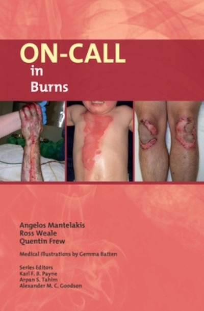 Cover for Angelos Mantelakis · On-Call in Burns - On-Call (Paperback Book) (2023)