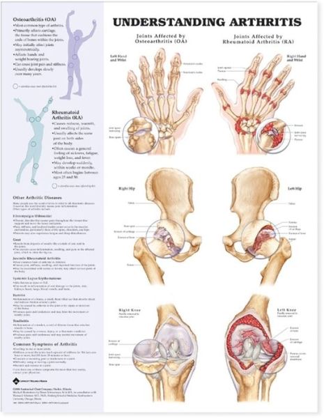 Cover for Anatomical Chart Com · Understanding Arthritis Anatomical Chart (Landkarten) (2004)