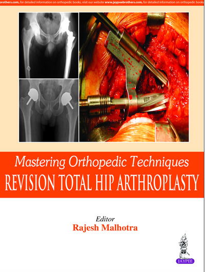 Cover for Rajesh Malhotra · Mastering Orthopedic Techniques: Revision Total Hip Arthroplasty (Inbunden Bok) (2016)