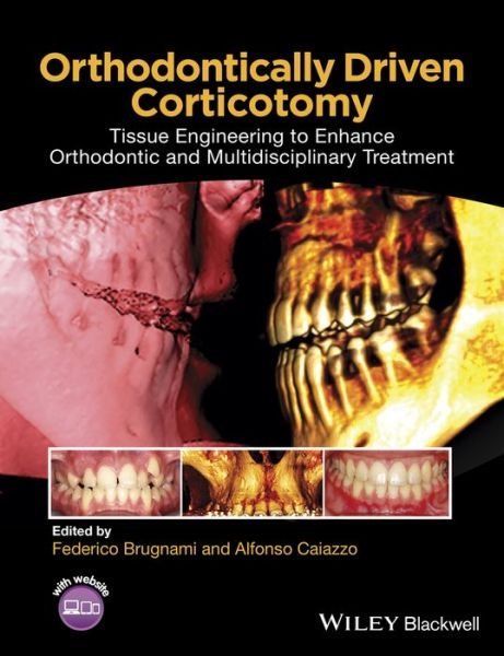 Cover for F Brugnami · Orthodontically Driven Corticotomy: Tissue Engineering to Enhance Orthodontic and Multidisciplinary Treatment (Hardcover Book) (2014)