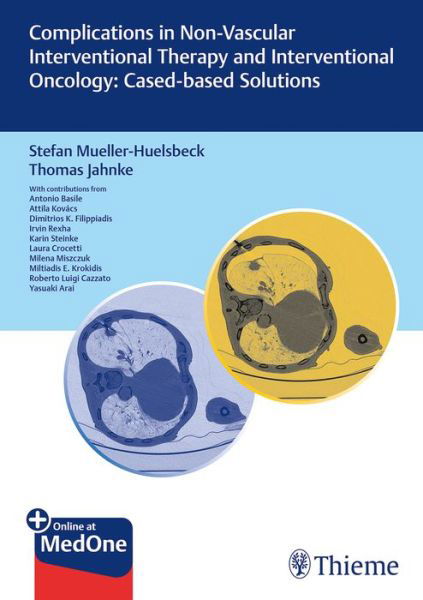 Complications in Non-vascular Interventional Therapy and Interventional Oncology: Case-based Solutions - Stefan Mueller-Huelsbeck - Livros - Thieme Publishing Group - 9783132412873 - 12 de junho de 2019