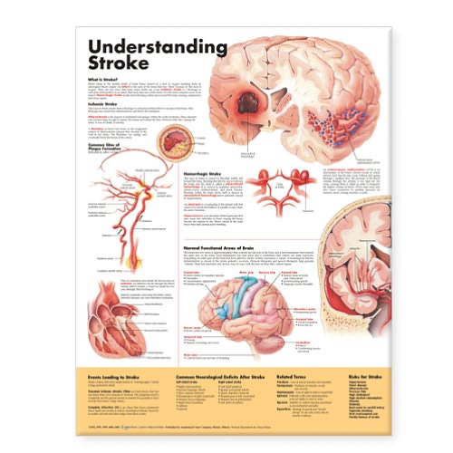 Cover for Acc · Understanding Stroke Anatomical Chart (Landkarten) (2006)