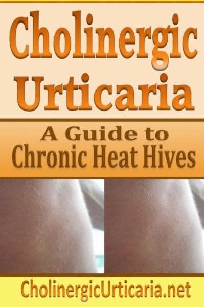 Cholinergic Urticaria: a Guide to Chronic Heat Hives - B Page - Livros - Createspace - 9781497387898 - 18 de março de 2014