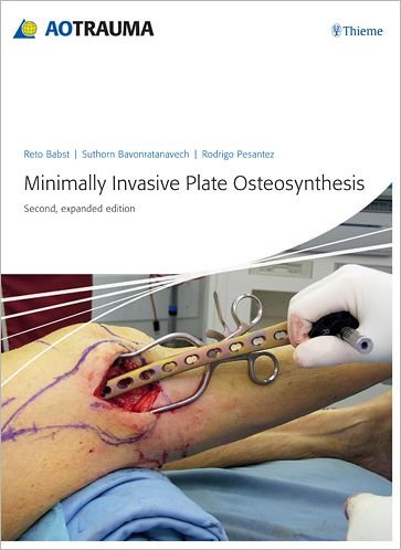 Minimally Invasive Plate Ostheosynthesis - AO-Publishing - Reto Babst - Books - Thieme Publishing Group - 9783131433923 - June 13, 2012