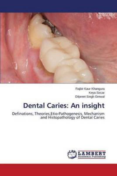 Cover for Grewal Dilpreet Singh · Dental Caries: an Insight (Pocketbok) (2015)