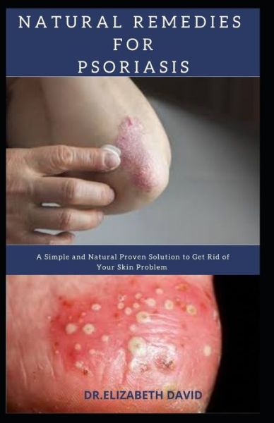 Cover for Dr Elizabeth David · Natural Remedies for Psoriasis (Paperback Book) (2020)