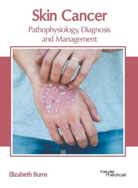 Cover for Elizabeth Burns · Skin Cancer: Pathophysiology, Diagnosis and Management (Hardcover Book) (2019)