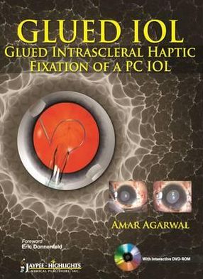 Cover for Amar Agarwal · GLUED IOL: Glued Intrascleral Haptic Fixation of a PC IOL (Hardcover Book) (2012)