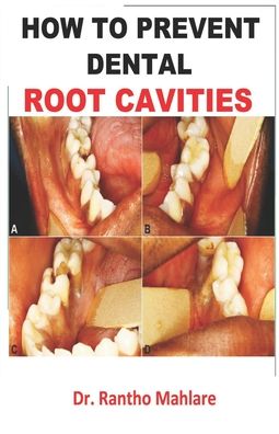 Cover for Rantho Mahlare · How to Prevent Dental Root Cavities (Paperback Book) (2020)