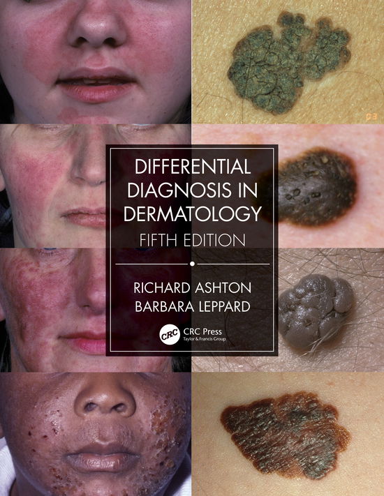 Cover for Richard Ashton · Differential Diagnosis in Dermatology (Paperback Book) (2021)